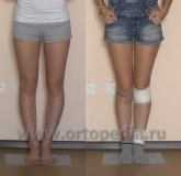 Ортопедическая операция по исправлению формы голеней в Волгограде с аппаратами Илизарова
