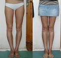 Фото до и после коррекции ног