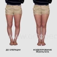 Улучшить форму ног и пропорции в клинике ортопедии
