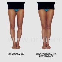 Кривые ноги с хорошо выраженными мышцами голеней - до и после операции