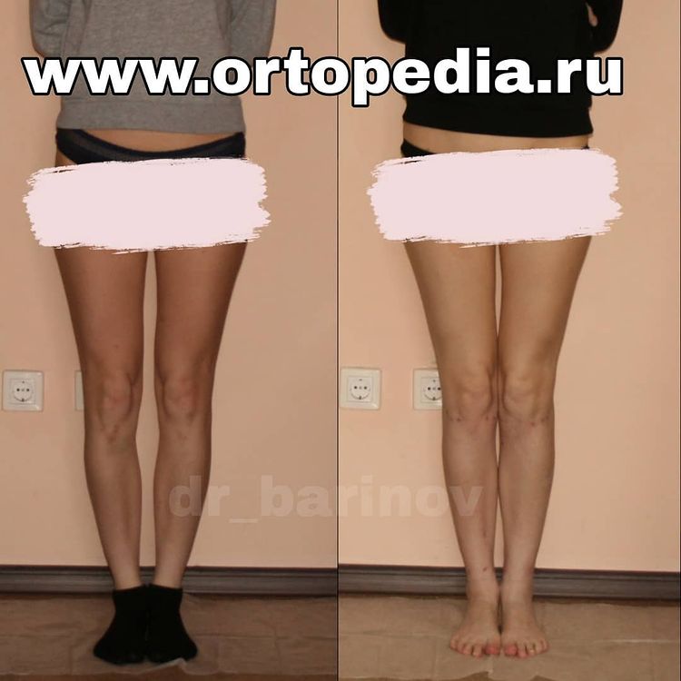 Результат исправления деформации ног с фиксацией аппаратами Илизарова