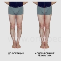 Как выпрямить кривые ноги у мужчин - моделирование