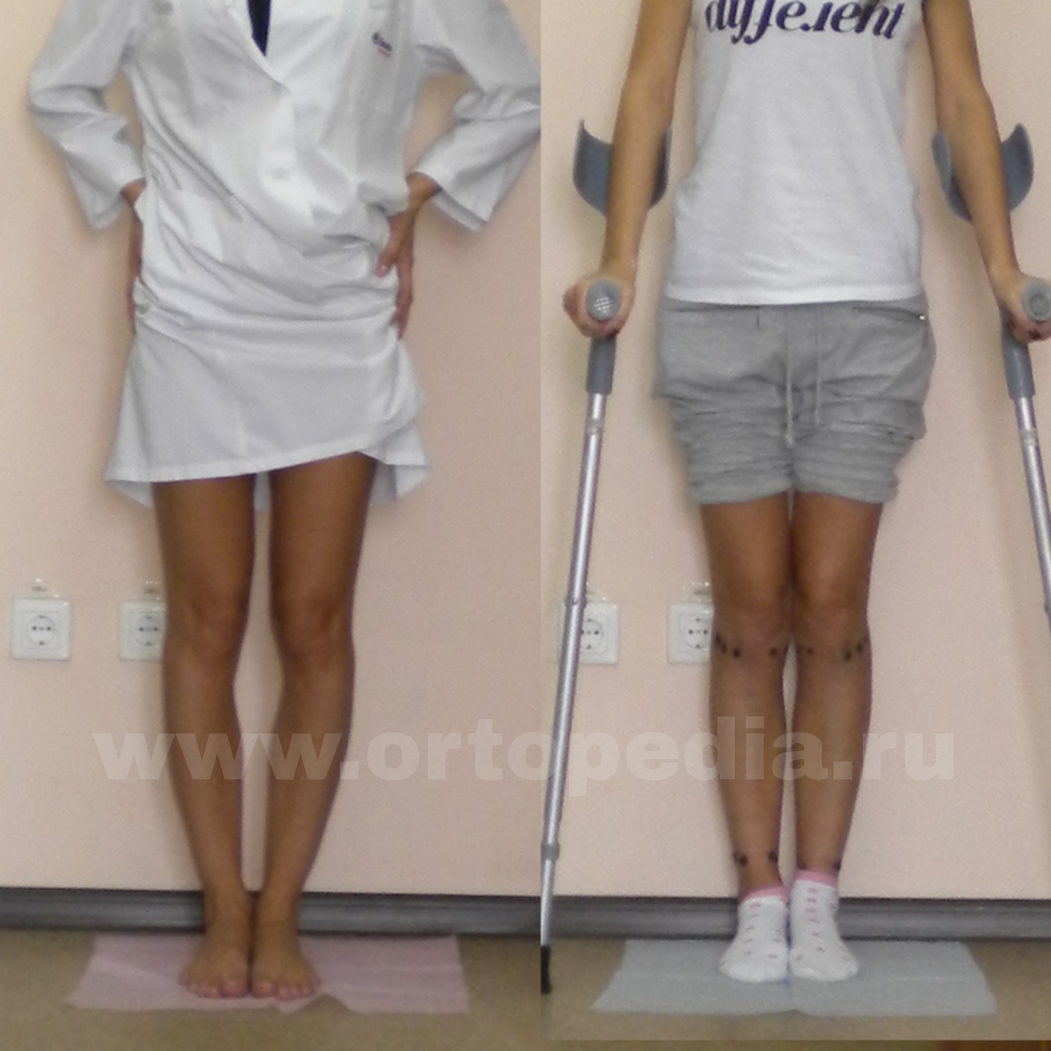 Коррекция голеней у женщин в клинике доктора Баринова Александра Сергеевича