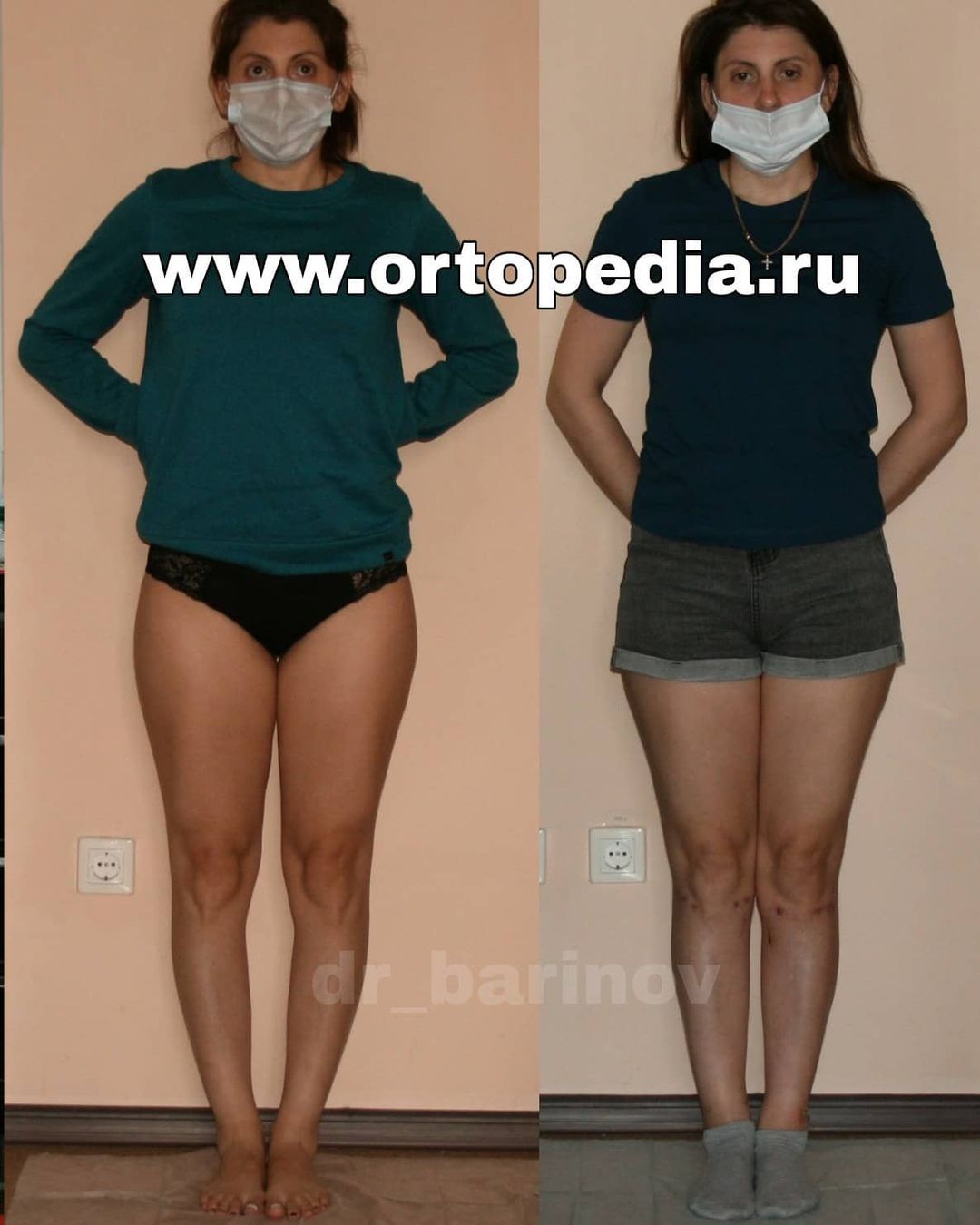 Результат исправления О-образной формы голеней в Волгограде