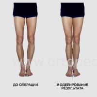 Коррекция О-образной формы ног у мужчин