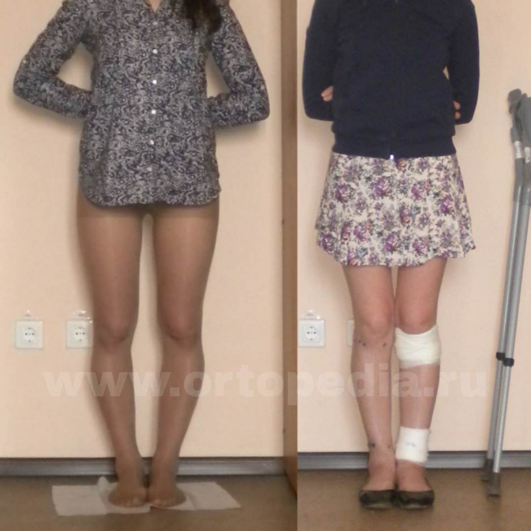 Коррекция ног в клинике Баринова Александра Сергеевича