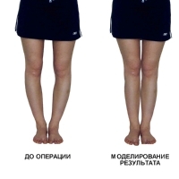 Волгоград ортопедия: лечения О-образного искривления ног