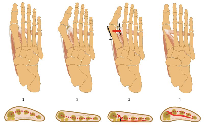 Коррекция hallux valgus. Описание операции: сухожильная пластика, пересадка сухожилия мышцы, приводящей 1 палец, на 1 плюсневую кость.